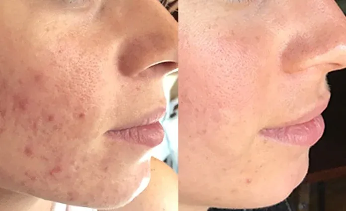 Microneedling before and after, example 1