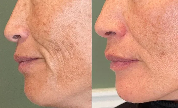 Microneedling before and after, example 2