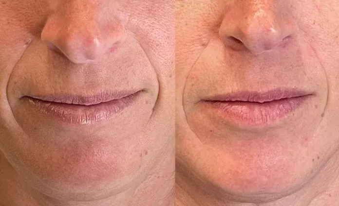 Microneedling before and after, example 3