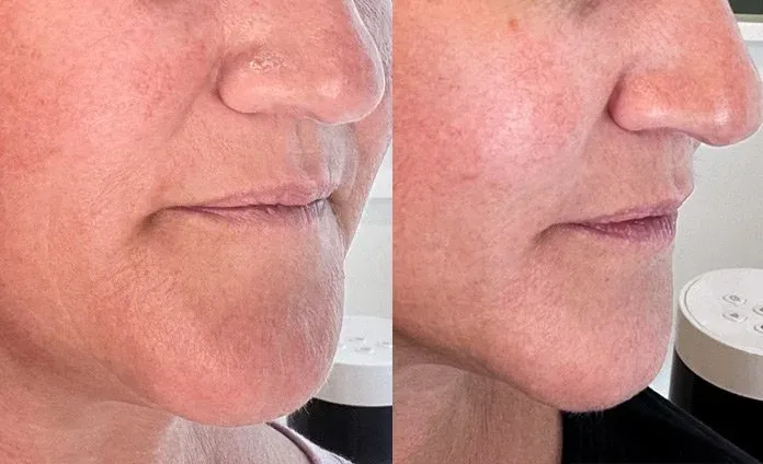 Microneedling before and after, example 4